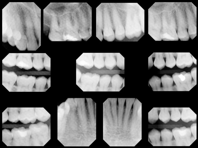 Dental XRays and Your Health Waterford, CT